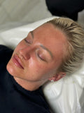 Microneedling with Lemon Bottle Skin Booster