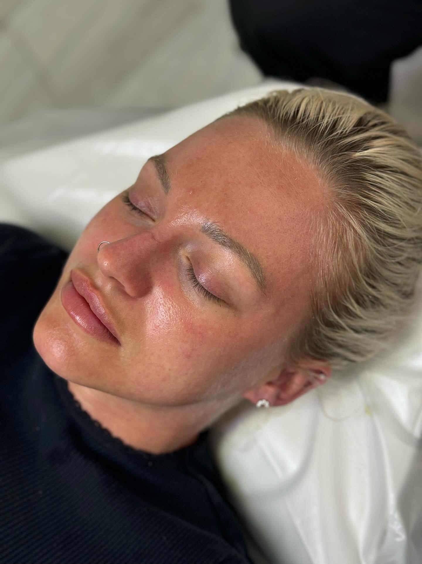Microneedling with Lemon Bottle Skin Booster