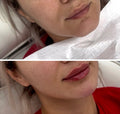 Facial Contouring Packages
