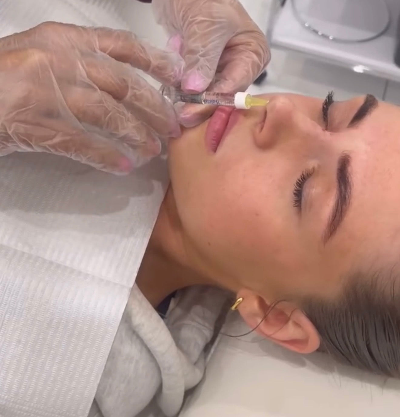 Non-Surgical Rhinoplasty / Nose Filler