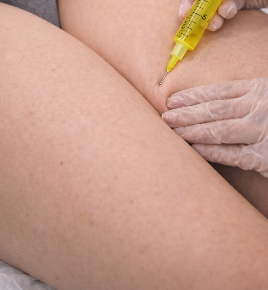 Fat Dissolving – Inner Thighs (Each Side)