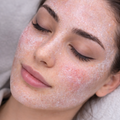 TCA Chemical Peel