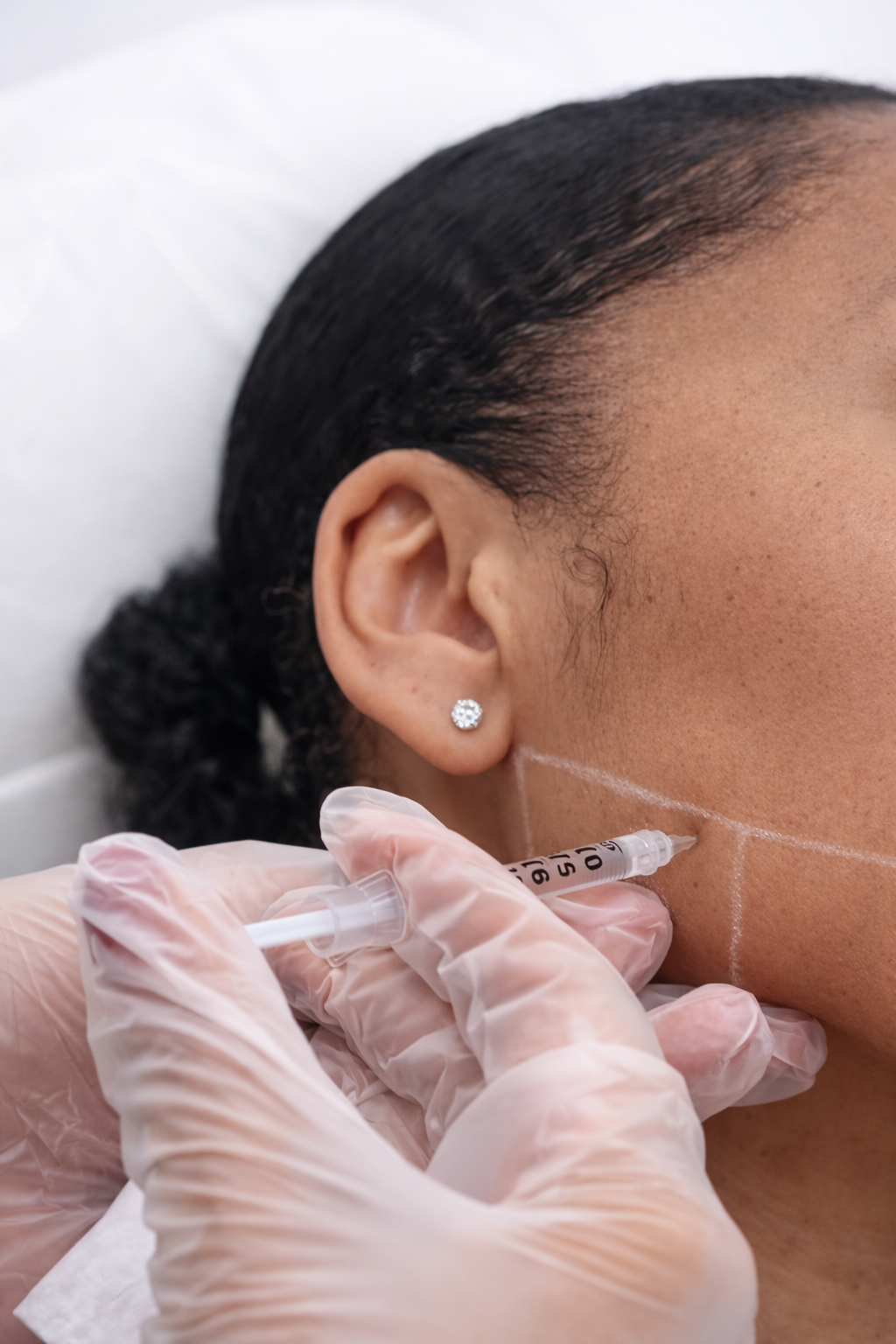 Masseter Botox / Jawline Slimming Consultation