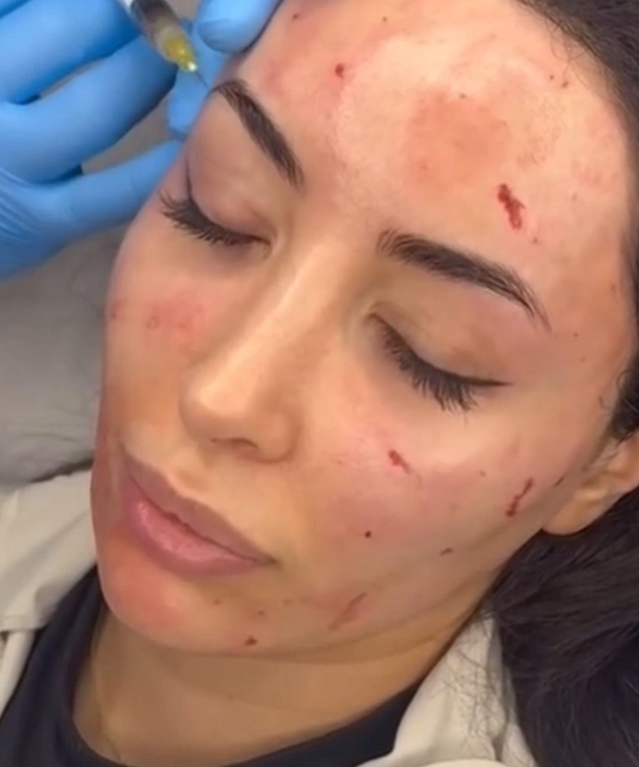 PRP – Vampire Facial