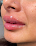 Lip Dissolving and 1ml Classic Lip Filler
