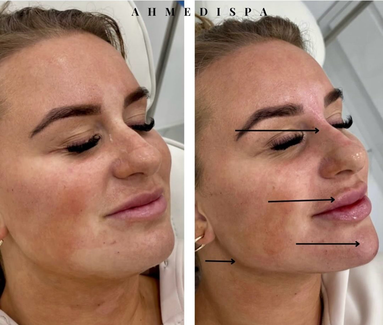 Facial Contouring Packages