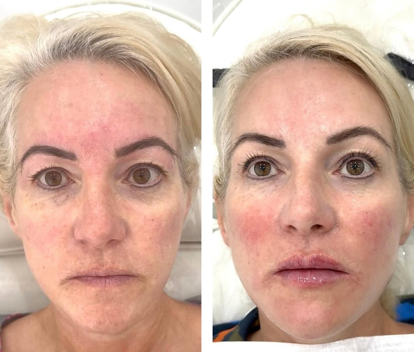 Facial Contouring Packages