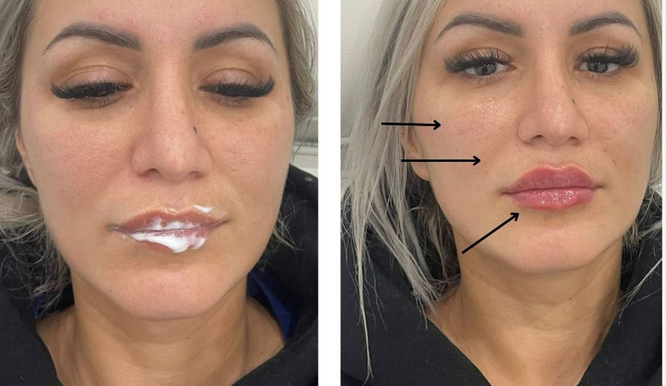 Facial Contouring Packages