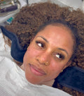 Microneedling