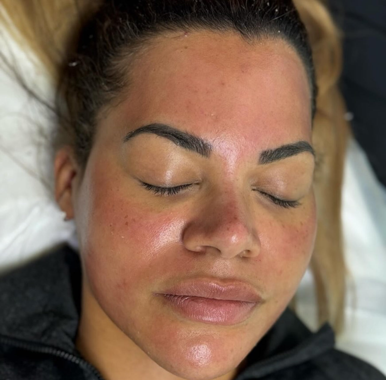 Microneedling with Pink Glow Serum