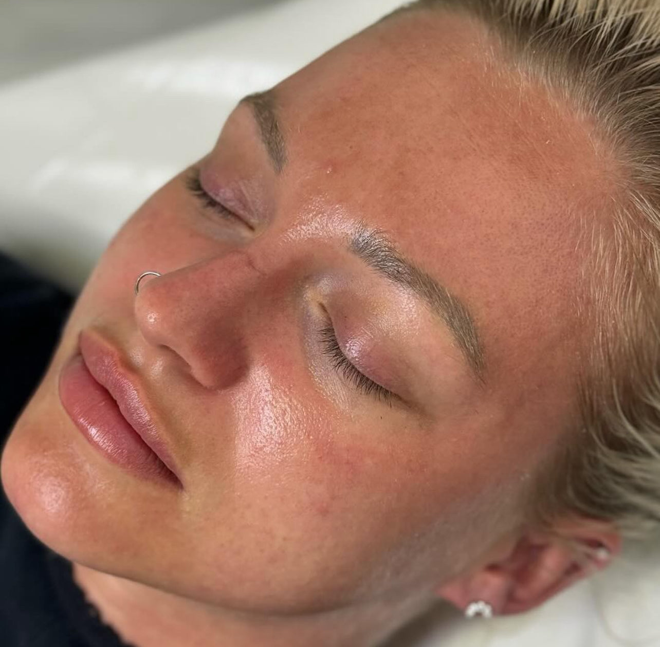Microneedling with Lemon Bottle Skin Booster